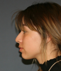 Feel Beautiful - Rhinoplasty 221 - Before Photo